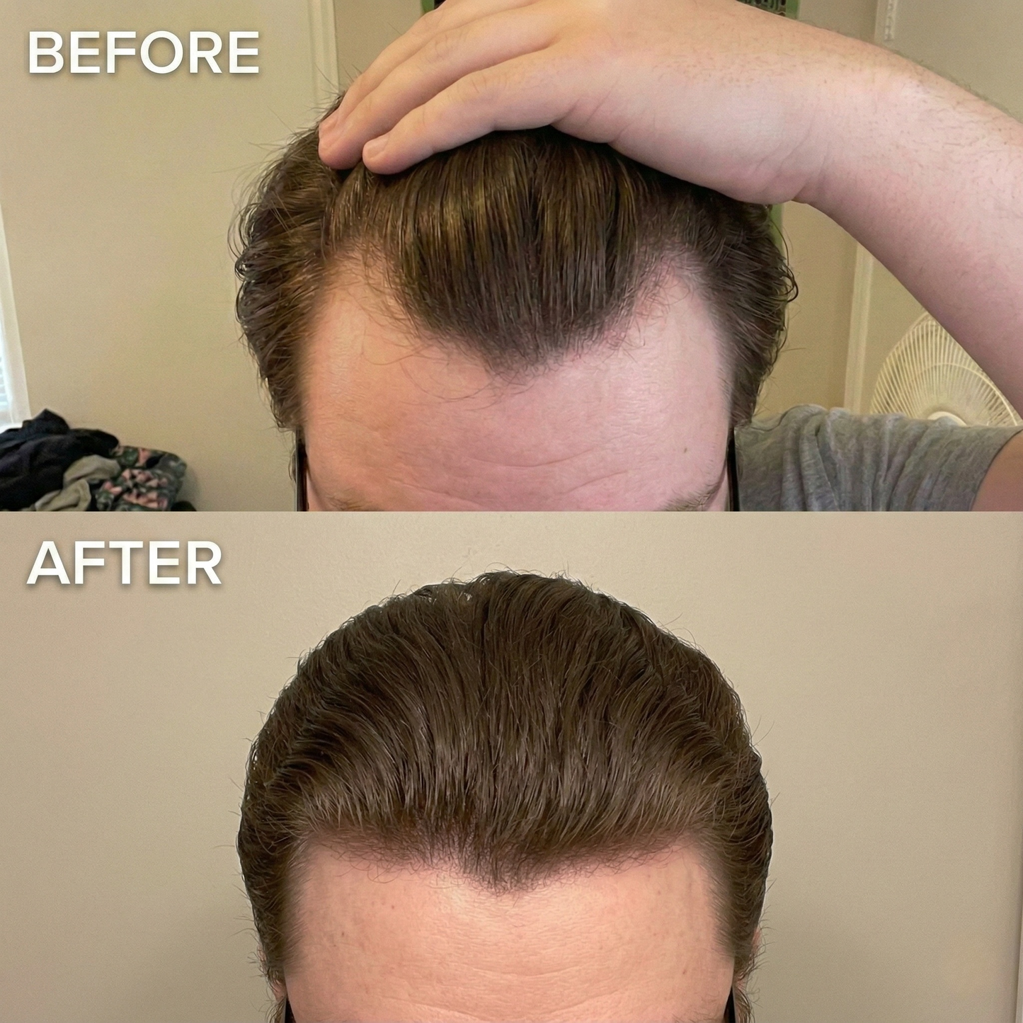 PrimalGrowth™ Hair Regrowth GHK-Cu Micro-Infusion System